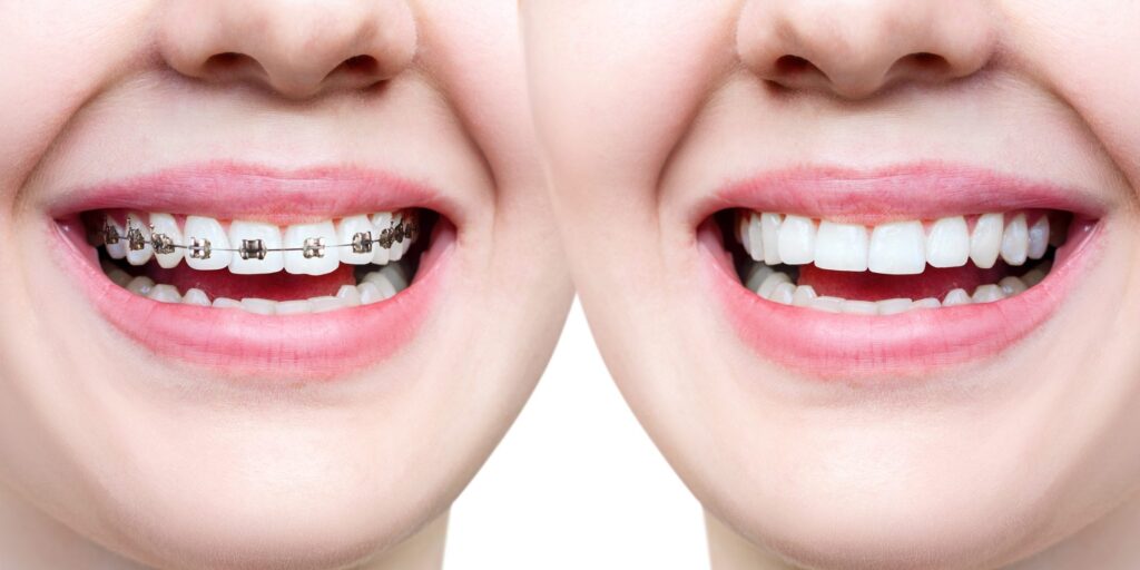 invisalign teeth treatment