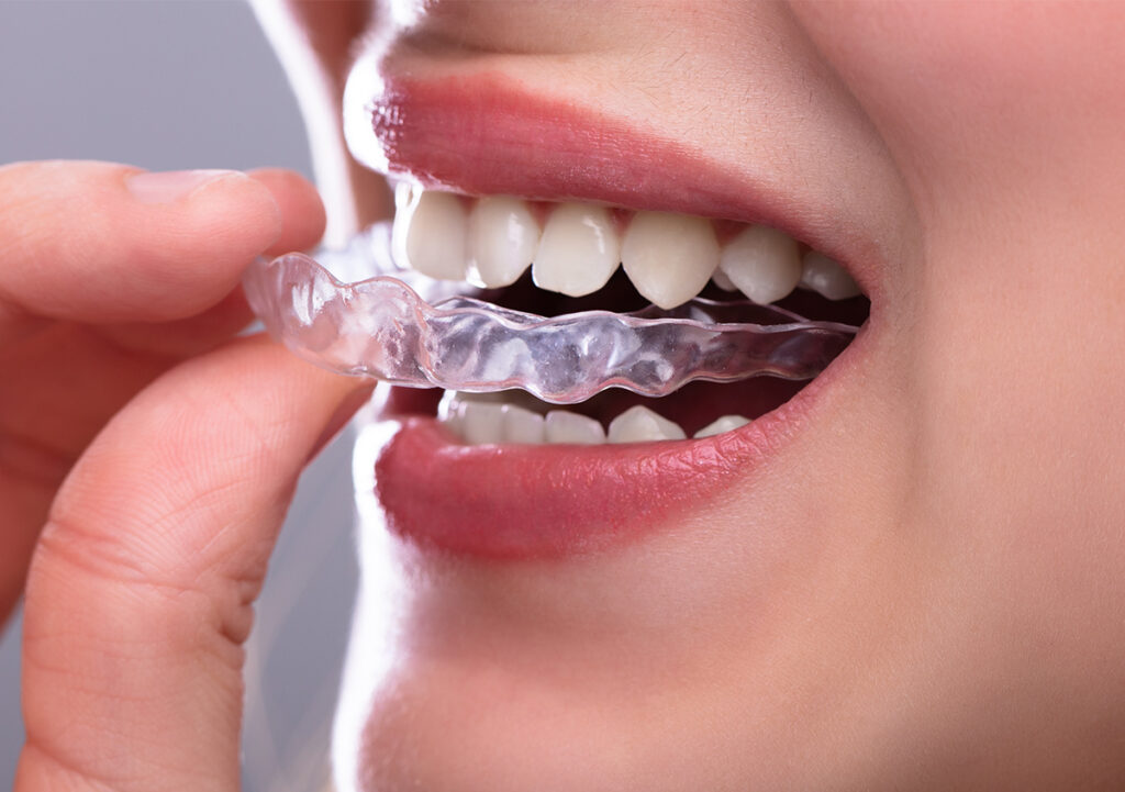 Invisalign in Century City